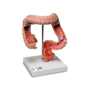 3B Scientific Intestinal Diseases Model