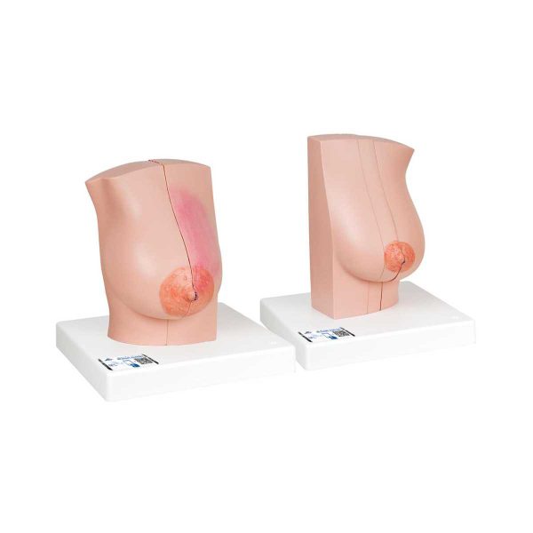 3B Scientific Model of Female Breast with Healthy and Unhealthy Tissue – 3B Smart Anatomy