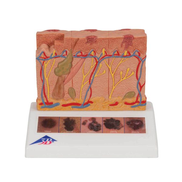 3B Scientific Skin Cancer Model with 5 stages, 8 times magnified – 3B Smart Anatomy